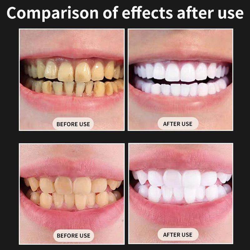 Kit de Clareamento Dental