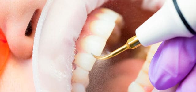 Limpador de dente ultrassonico